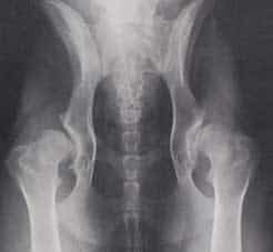 Severe Hip Dysplasia and Osteoarthritis- Arthritis